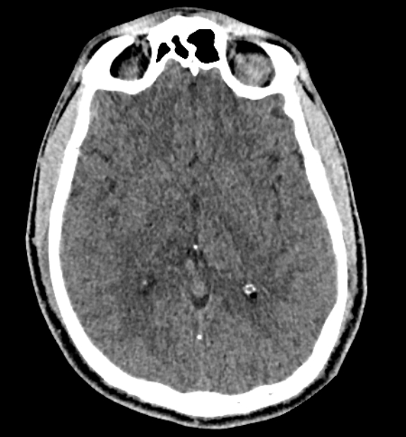 Acute ischemic stroke - posterior circulation territory (Radiopaedia 77670-89881 non-contrast 44).jpg