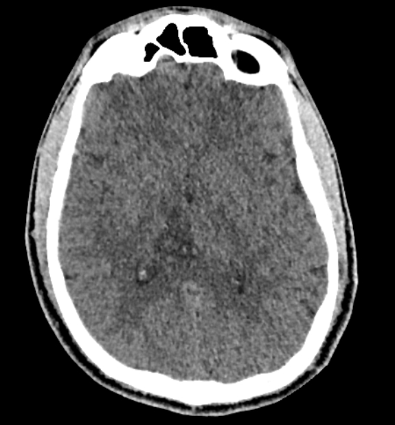 Acute ischemic stroke - posterior circulation territory (Radiopaedia 77670-89881 non-contrast 46).jpg