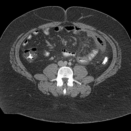 Acute mesenteric venous ischemia (Radiopaedia 46041-50383 Axial C+ portal venous phase 75).jpg