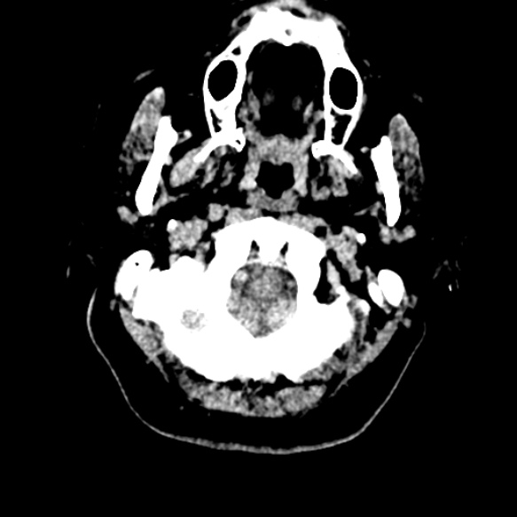 Acute middle cerebral artery territory infarct (Radiopaedia 52380-58283 Axial non-contrast 2).jpg