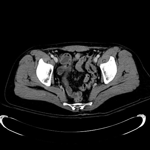 Acute myocardial infarction in CT (Radiopaedia 39947-42415 Axial C+ portal venous phase 118).jpg
