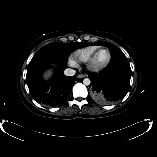 File:Acute myocardial infarction in CT (Radiopaedia 39947-42457 Axial C+ portal venous phase 12).jpg