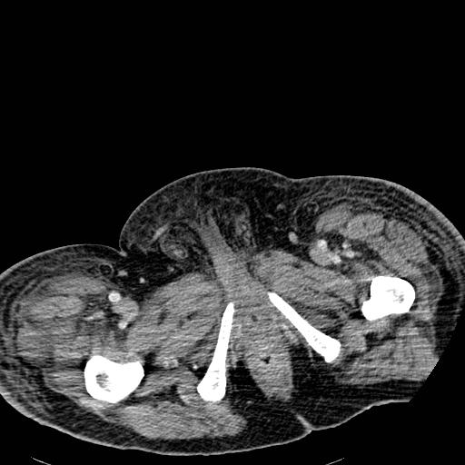Acute pancreatic necrosis (Radiopaedia 13560-18501 Axial C+ portal venous phase 159).jpg