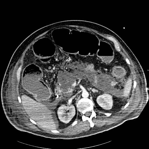 File:Acute pancreatic necrosis (Radiopaedia 13560-18502 Axial C+ portal venous phase 29).jpg