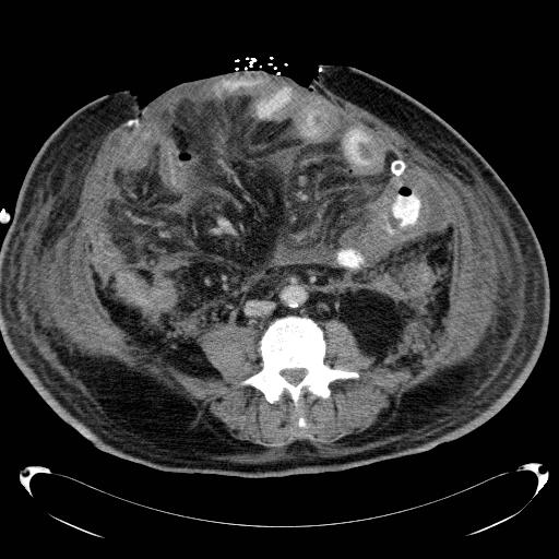 Acute pancreatic necrosis (Radiopaedia 13560-18503 Axial C+ portal venous phase 47).jpg