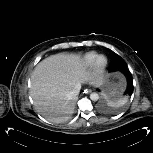 Acute pancreatic necrosis (Radiopaedia 13560-18503 Axial C+ portal venous phase 6).jpg