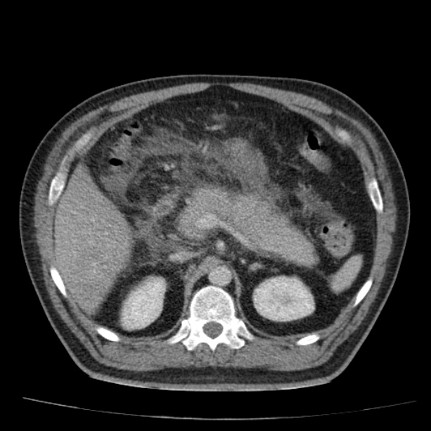Acute pancreatitis (Radiopaedia 26663-26813 Axial C+ portal venous phase 27).jpg