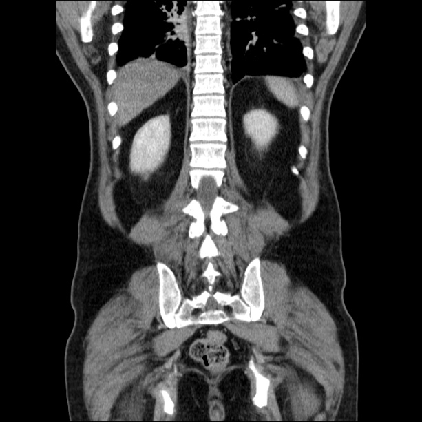 Acute pancreatitis (Radiopaedia 26663-26813 Coronal C+ portal venous phase 50).jpg