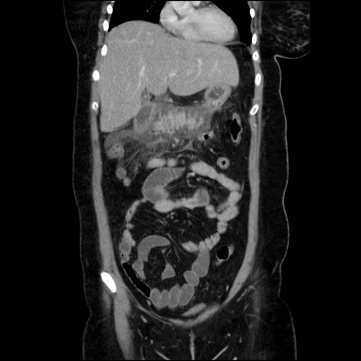 Acute pancreatitis (Radiopaedia 69236-79012 Coronal C+ portal venous phase 50).jpg