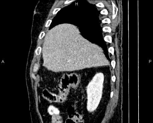 Acute pancreatitis (Radiopaedia 85146-100701 Sagittal C+ portal venous phase 16).jpg