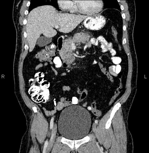 File:Acute pancreatitis (Radiopaedia 85390-101010 Coronal C+ portal venous phase 26).jpg
