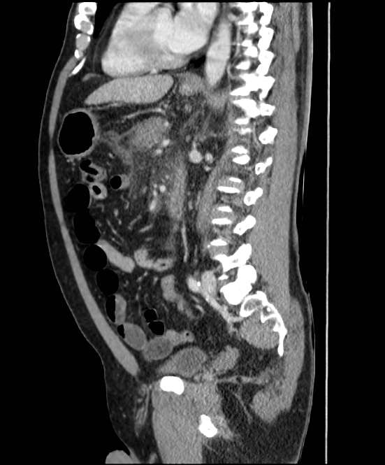 Acute pancreatitis - Balthazar E (Radiopaedia 23080-23110 Sagittal C+ portal venous phase 57).jpg