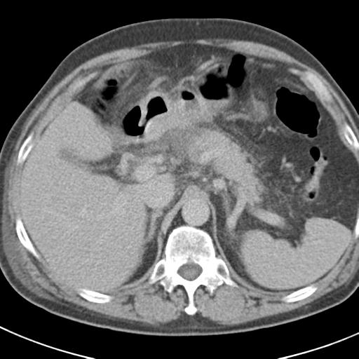 Acute pancreatitis and walled-off necrosis (Radiopaedia 29888-30403 Axial C+ delayed 24).jpg