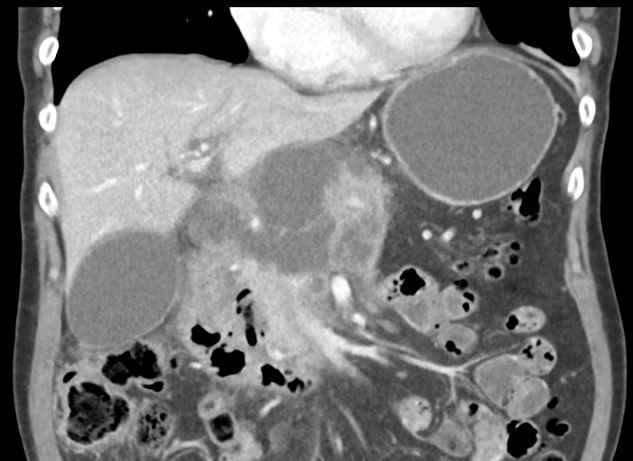 Acute pancreatitis and walled-off necrosis (Radiopaedia 29888-30404 Coronal C+ portal venous phase 22).jpg