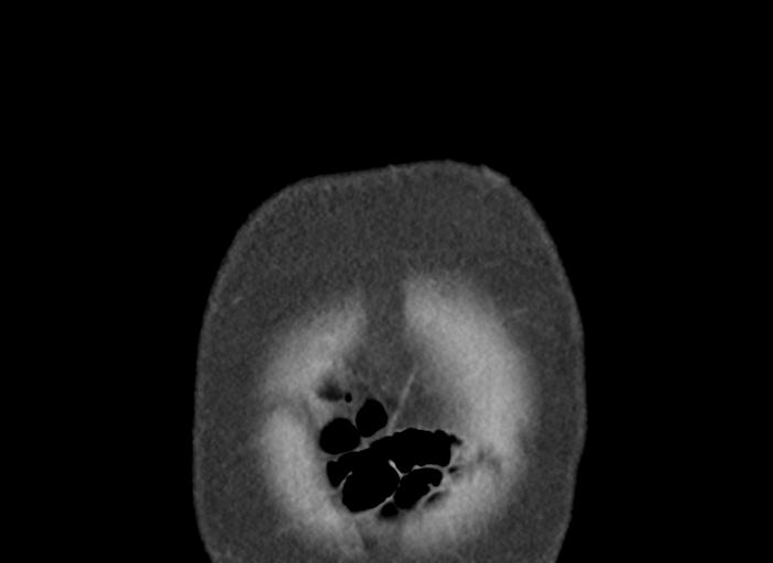 Acute pancreatitis and walled-off necrosis (Radiopaedia 29888-30404 Coronal C+ portal venous phase 4).jpg