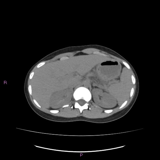 Acute pancreatitis secondary to stone at minor papilla and pancreatic divisum (Radiopaedia 76570-88333 Axial non-contrast 19).jpg