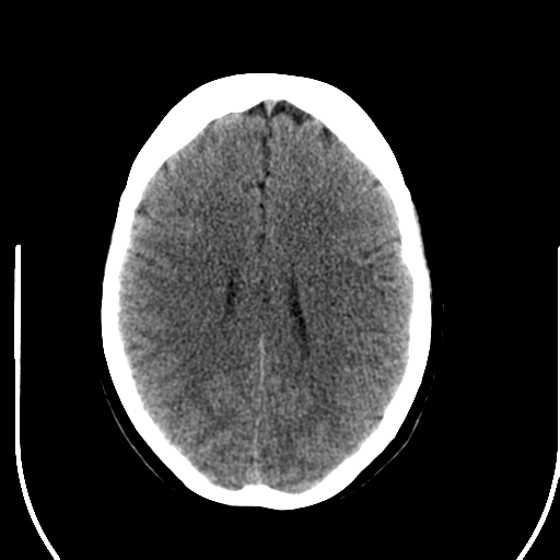 File:Acute pontine infarct from vertebral artery dissection (Radiopaedia 34111-35369 Axial non-contrast 19).png