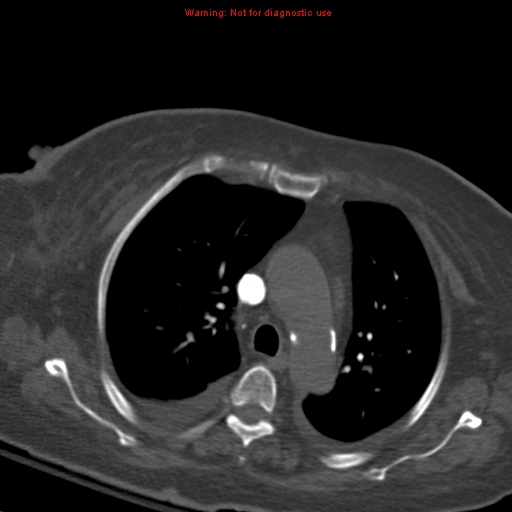 File:Acute pulmonary embolism (Radiopaedia 13286-13289 Axial C+ CTPA 24).jpg