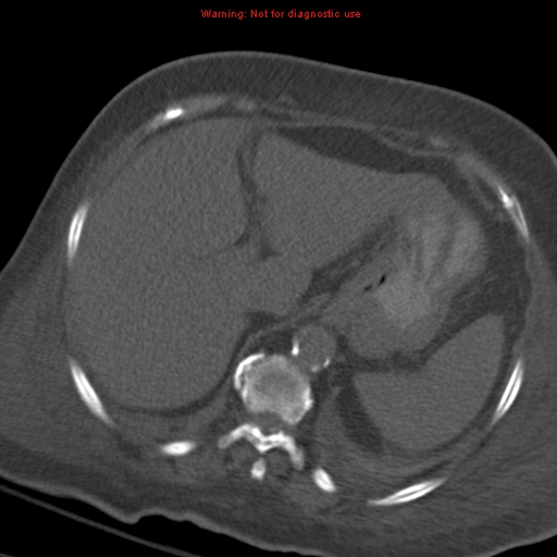 Acute pulmonary embolism (Radiopaedia 13286-13289 Axial C+ CTPA 64).jpg