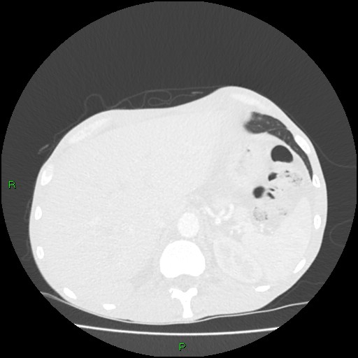 File:Acute right lung abscess (Radiopaedia 34806-36258 Axial lung window 180).jpg