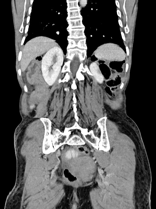 Acute small bowel (ileal) volvulus (Radiopaedia 71740-82139 Coronal C+ portal venous phase 87).jpg