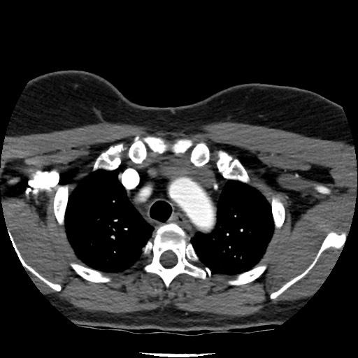 Acute subarachnoid hemorrhage and accessory anterior cerebral artery (Radiopaedia 69231-79009 Axial C+ arterial phase 17).jpg