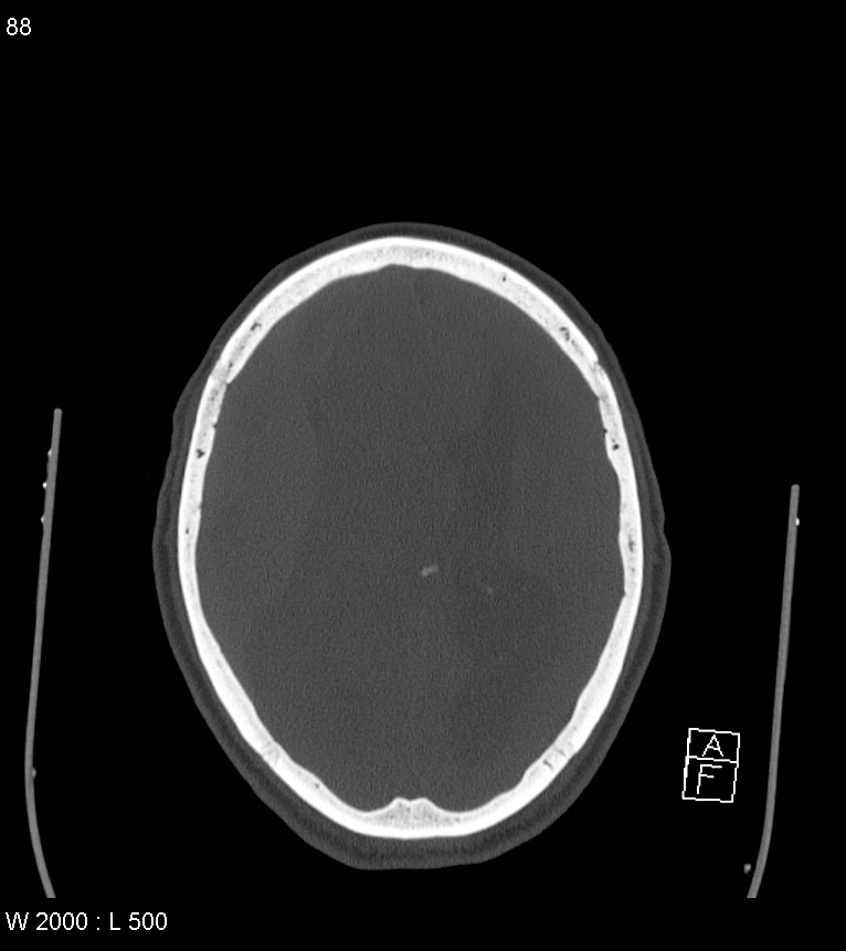 Acute subdural hematoma with myelofibrosis (Radiopaedia 52582-58494 Axial bone window 44).jpg