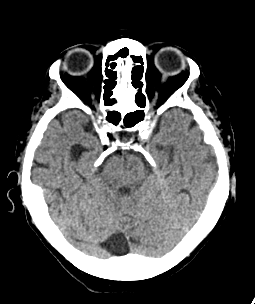 Acute traumatic subdural hematoma (Radiopaedia 82921-97257 Axial non-contrast 44).jpg