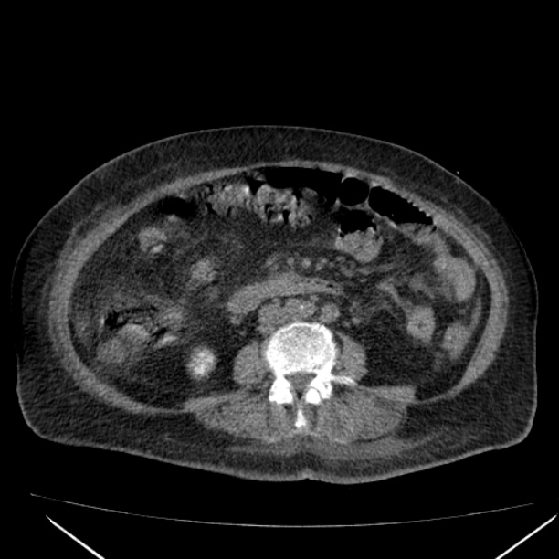 Acute tubular necrosis (Radiopaedia 28077-28334 Axial non-contrast 38).jpg