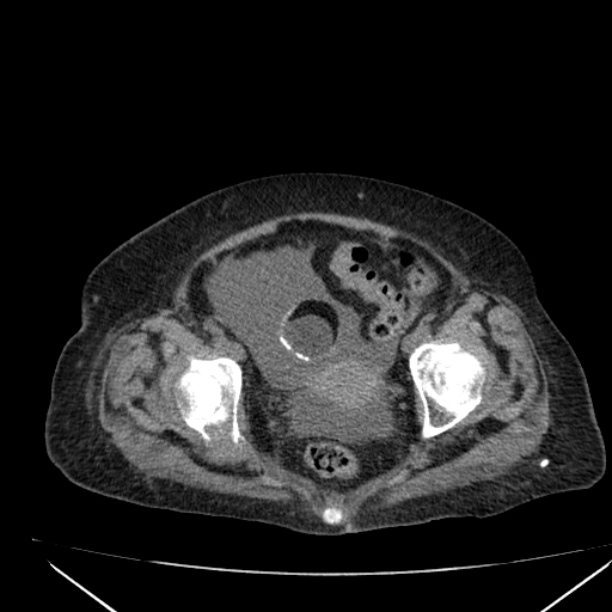 Acute tubular necrosis (Radiopaedia 28077-28334 Axial non-contrast 62).jpg
