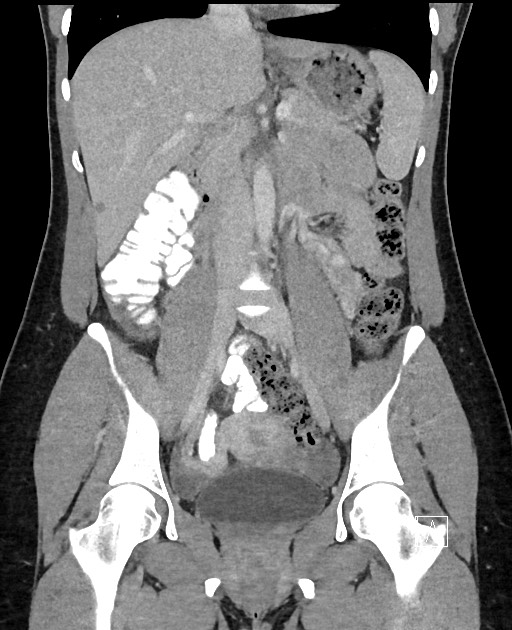 Acute uncomplicated appendicitis (Radiopaedia 61374-69304 Coronal C+ portal venous phase 51).jpg