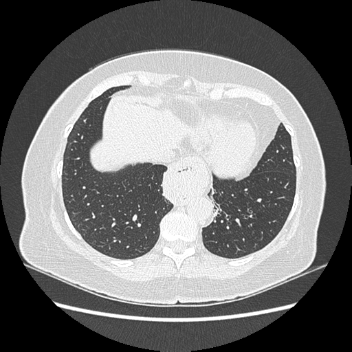 Adenocarcinoma in situ of lung (Radiopaedia 38685-40829 B 172).png