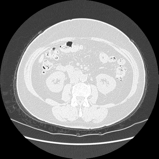 Adenocarcinoma in situ of lung (Radiopaedia 38685-40829 B 279).png