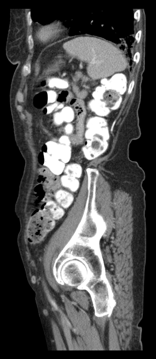 Adenocarcinoma of cecum (Radiopaedia 59222-66549 Sagittal C+ portal venous phase 13).jpg