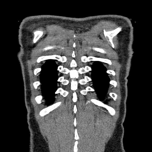 Adenocarcinoma of the lung (Radiopaedia 59871-67325 Coronal C+ arterial phase 69).jpg