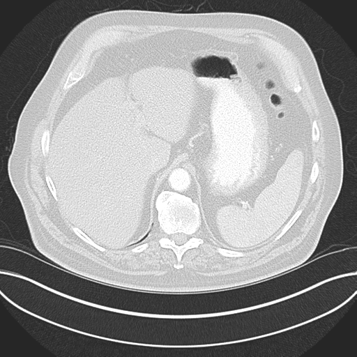 Adenocarcioma of rectum- T1 lesion (Radiopaedia 36921-38547 Axial lung window 51).png