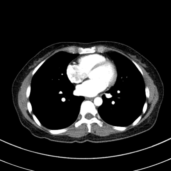Adenocystic carcinoma of the trachea (Radiopaedia 47677-52525 Axial C+ arterial phase 58).jpg