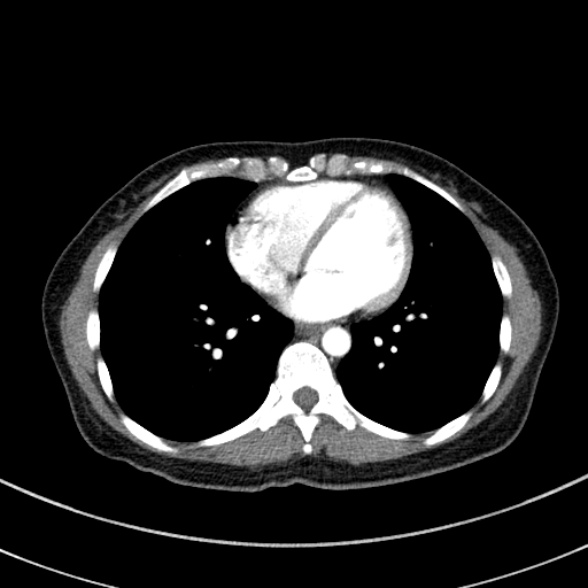 Adenocystic carcinoma of the trachea (Radiopaedia 47677-52525 Axial C+ arterial phase 61).jpg