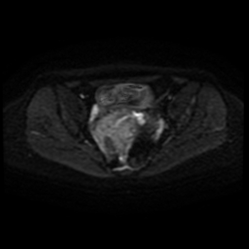 Adenoma malignum of cervix (Radiopaedia 66441-75705 Axial DWI 35).jpg