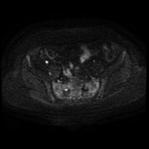 Adenoma malignum of cervix (Radiopaedia 66441-75705 Axial DWI 78).jpg