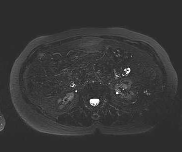 File:Adenomyomatosis of the gallbladder (Radiopaedia 50246-55587 Axial 12).png