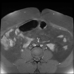 File:Adenomyosis within a didelphys uterus (Radiopaedia 70175-80215 Axial T1 C+ fat sat 6).jpg