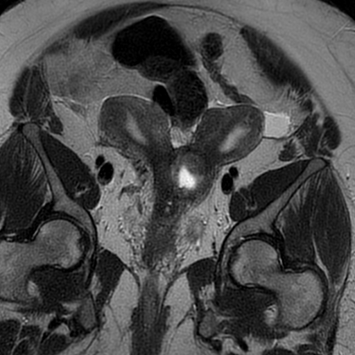 File:Adenomyosis within a didelphys uterus (Radiopaedia 70175-80215 Coronal T2 15).jpg