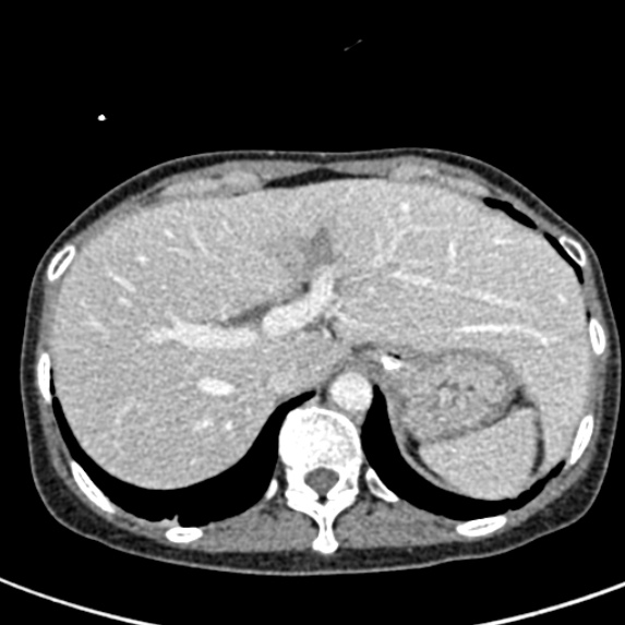 Adhesional small bowel obstruction (Radiopaedia 48397-53305 Axial C+ portal venous phase 10).jpg