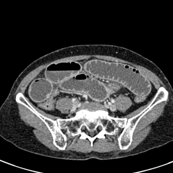 Adhesional small bowel obstruction (Radiopaedia 48397-53305 Axial C+ portal venous phase 64).jpg