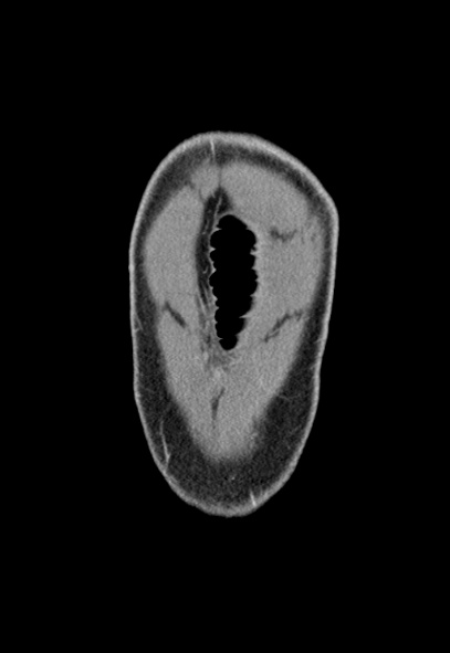 File:Adhesional small bowel obstruction (Radiopaedia 52107-57980 Coronal C+ portal venous phase 3).jpg