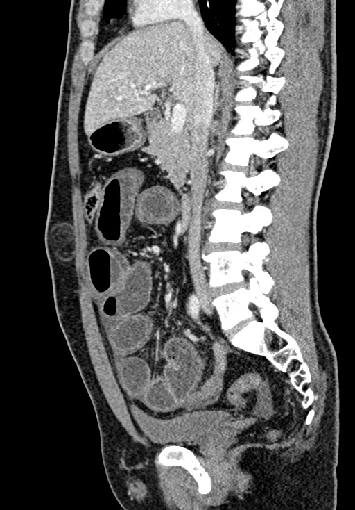 Adhesional small bowel obstruction (Radiopaedia 58900-66131 Sagittal C+ portal venous phase 110).jpg
