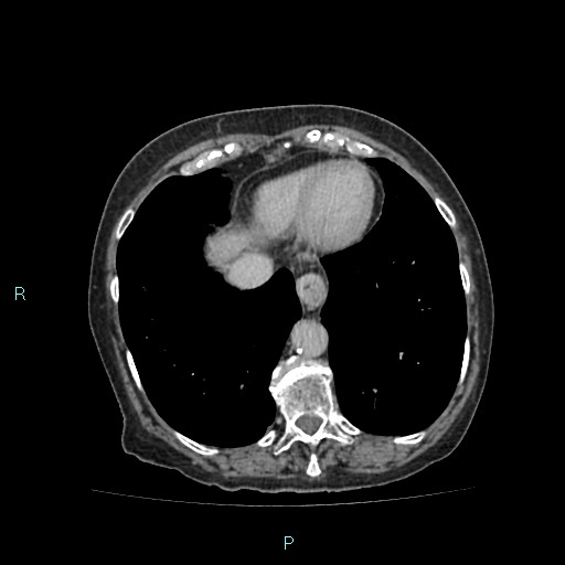 File:Adrenal collision tumor (ACT) (Radiopaedia 48462-53379 Axial C+ delayed 7).jpg