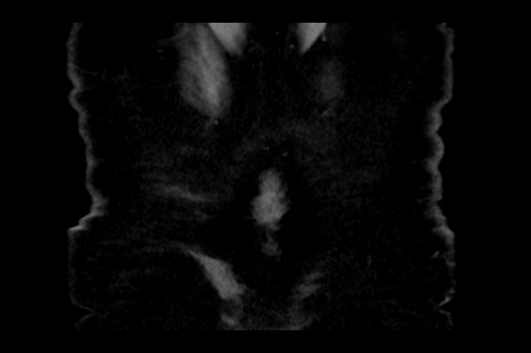 Adrenal cortical carcinoma (Radiopaedia 64017-72769 Coronal non-contrast 58).jpg
