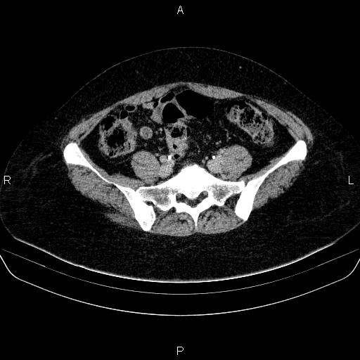 Adrenal cortical carcinoma (Radiopaedia 84882-100379 Axial C+ delayed 69).jpg